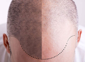 Na czym polega przeszczep włosów za pomocą robota Artas ix? przeszczep włosów